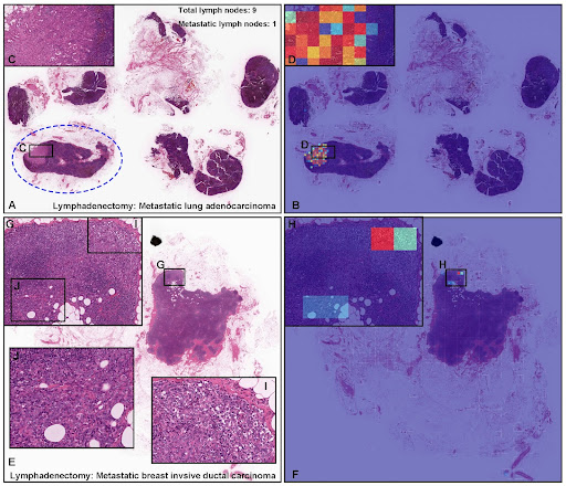 メドメイン、広汎な臓器で腺癌の形態的特徴を認識・検出できるディープラーニング型AIの開発に成功